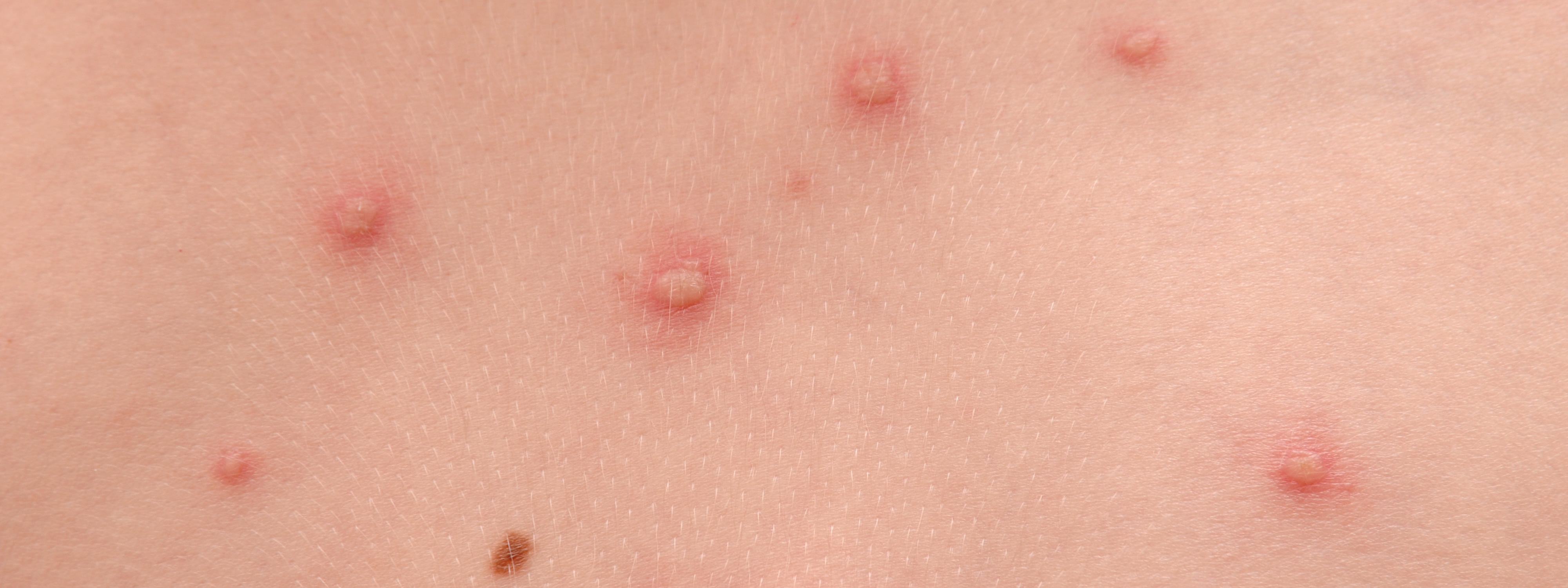 boutons de varicelle